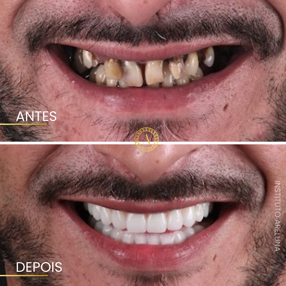 Reabilitação oral com prótese fixa - Antes e Depois