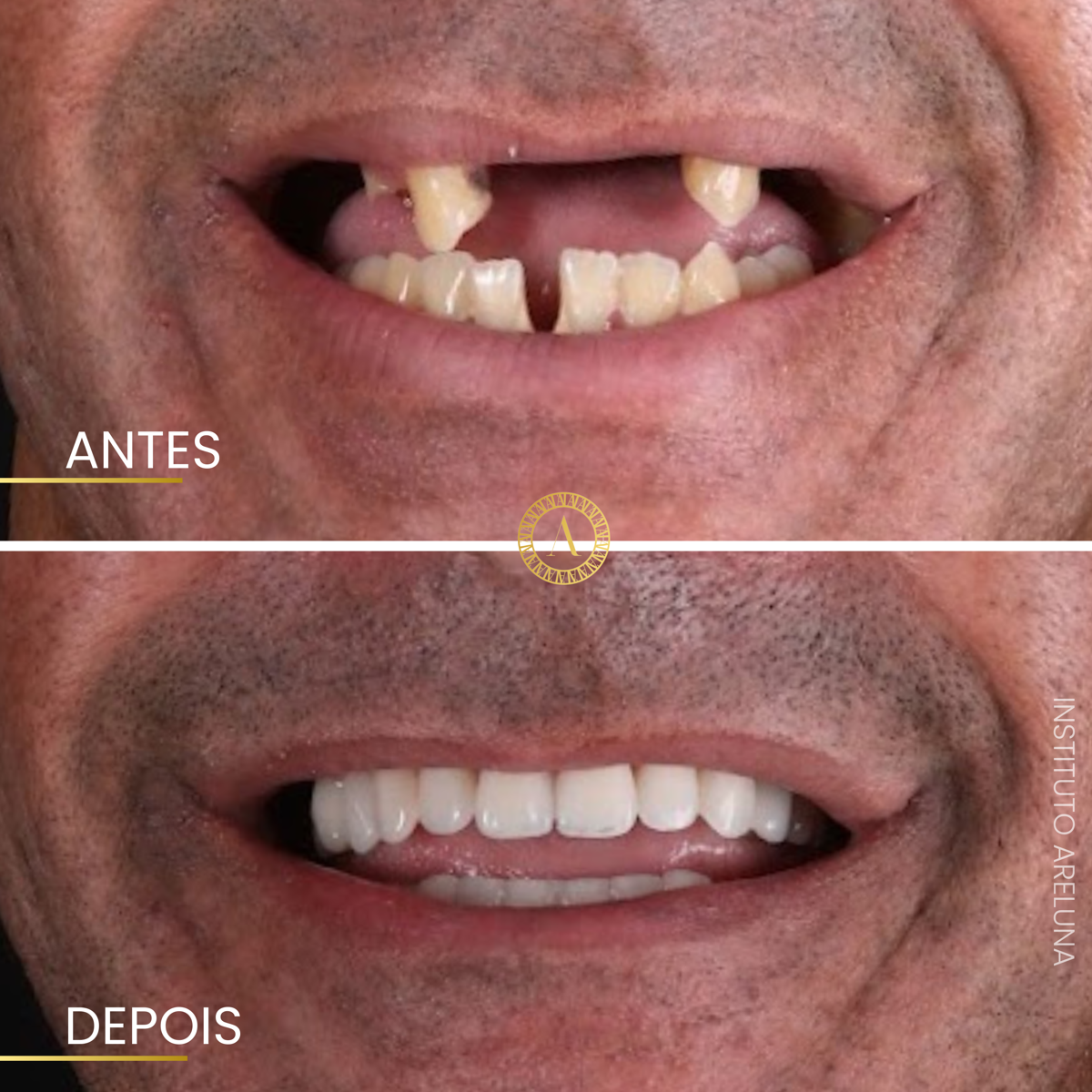 Implantes e reabilitação - Antes e Depois