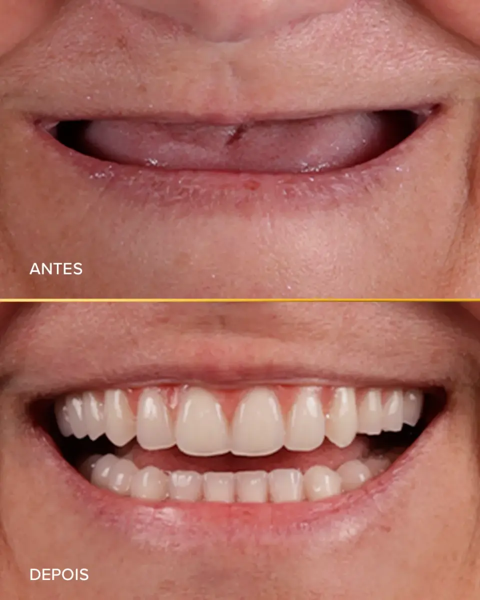 Reconstrução dentária - Antes e Depois