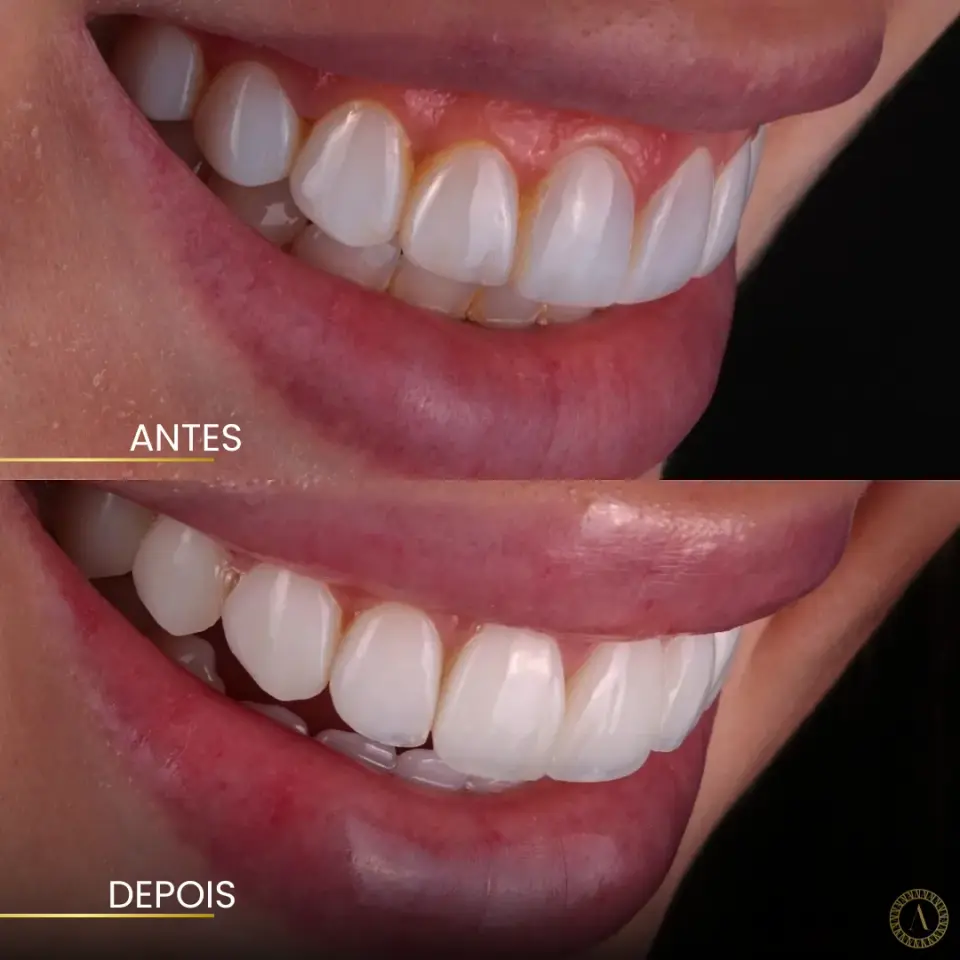 Facetas personalizadas - Antes e Depois