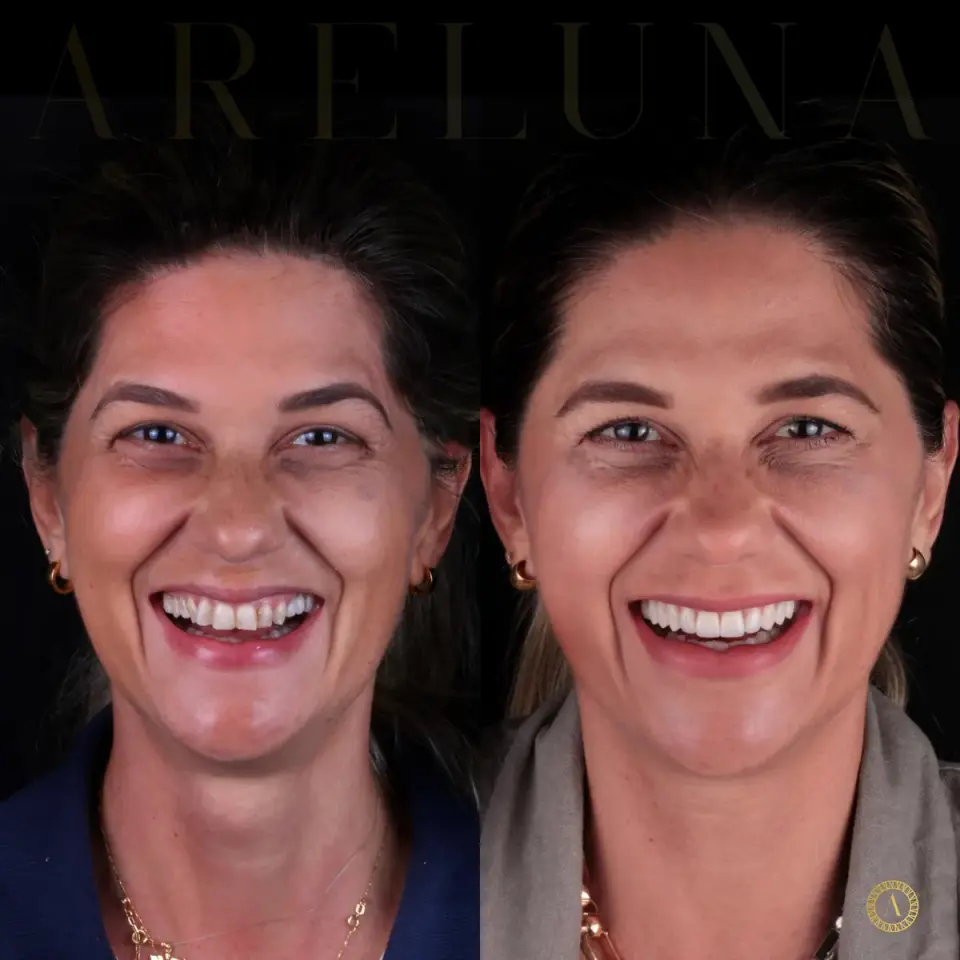 Facetas cerâmicas - Antes e Depois