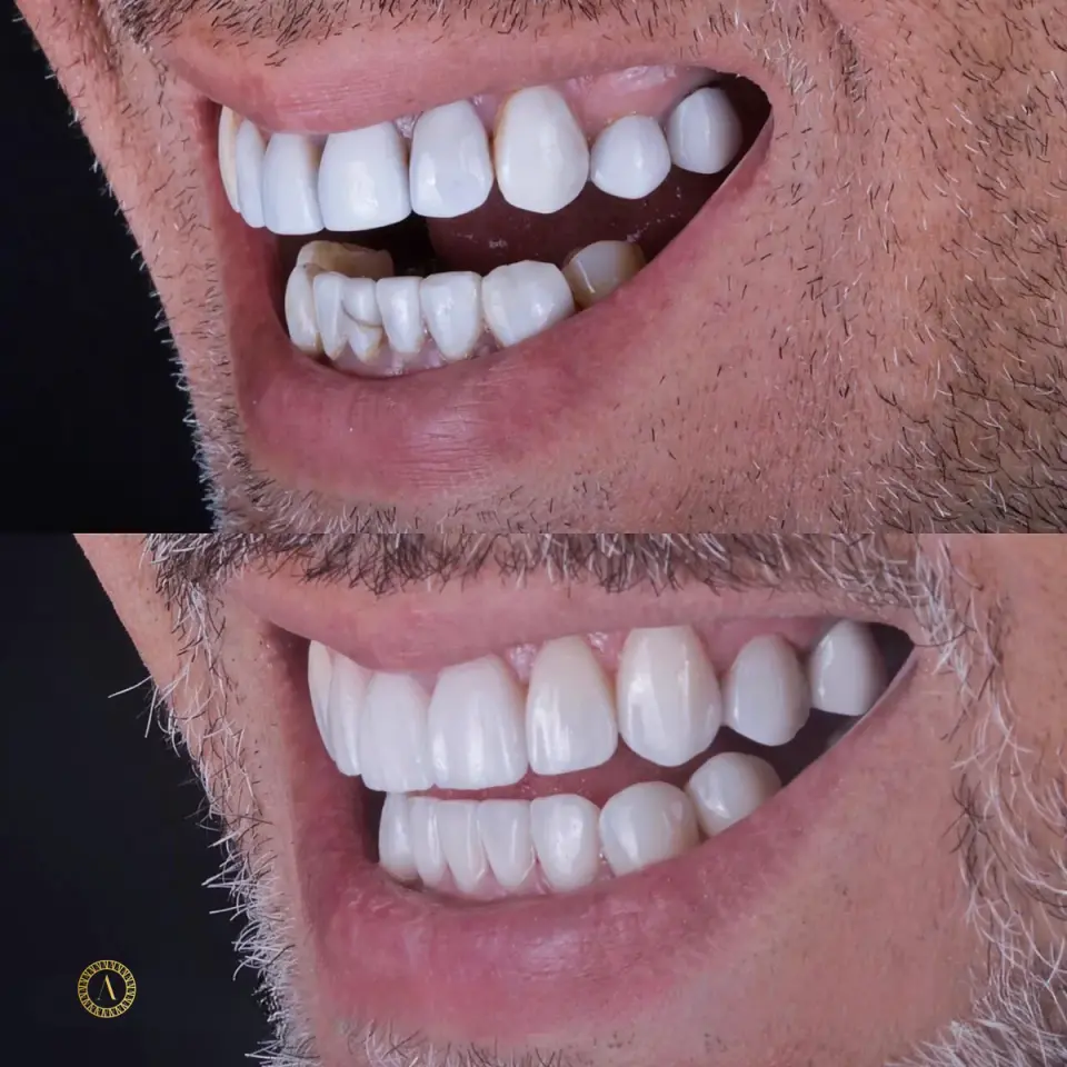Facetas ultrafinas - Antes e Depois