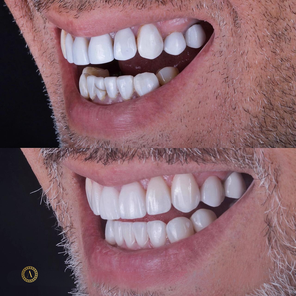 Facetas ultrafinas - Antes e Depois