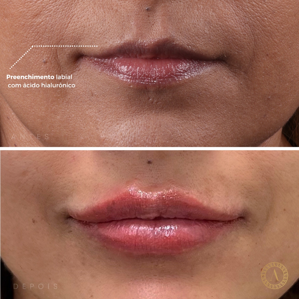 Caso 3 - Estética Facial Premium