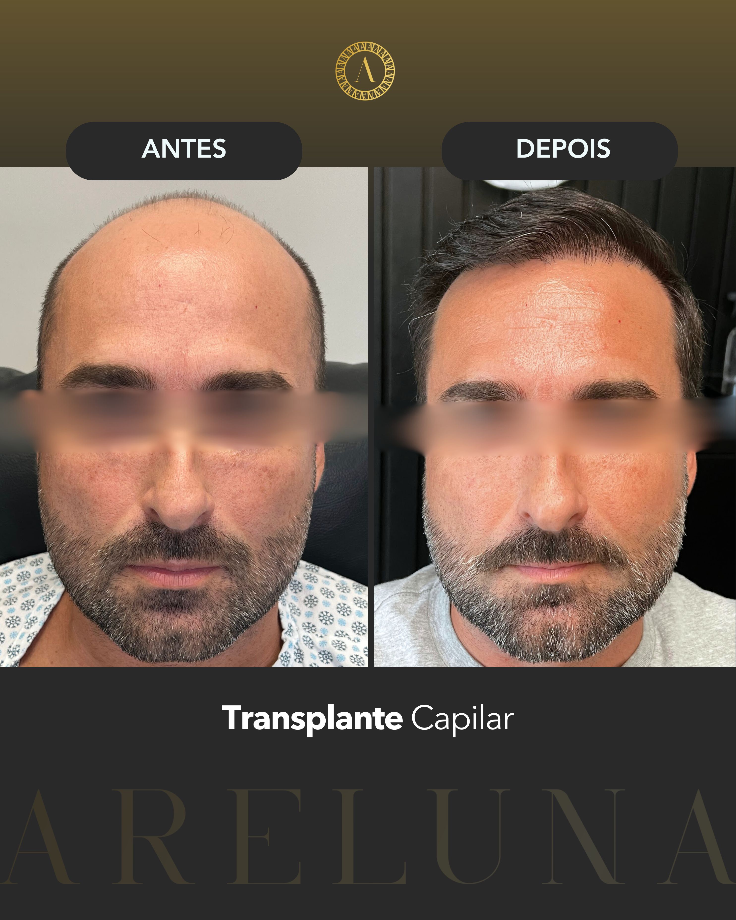 Caso 1 - Transplante Capilar FUE