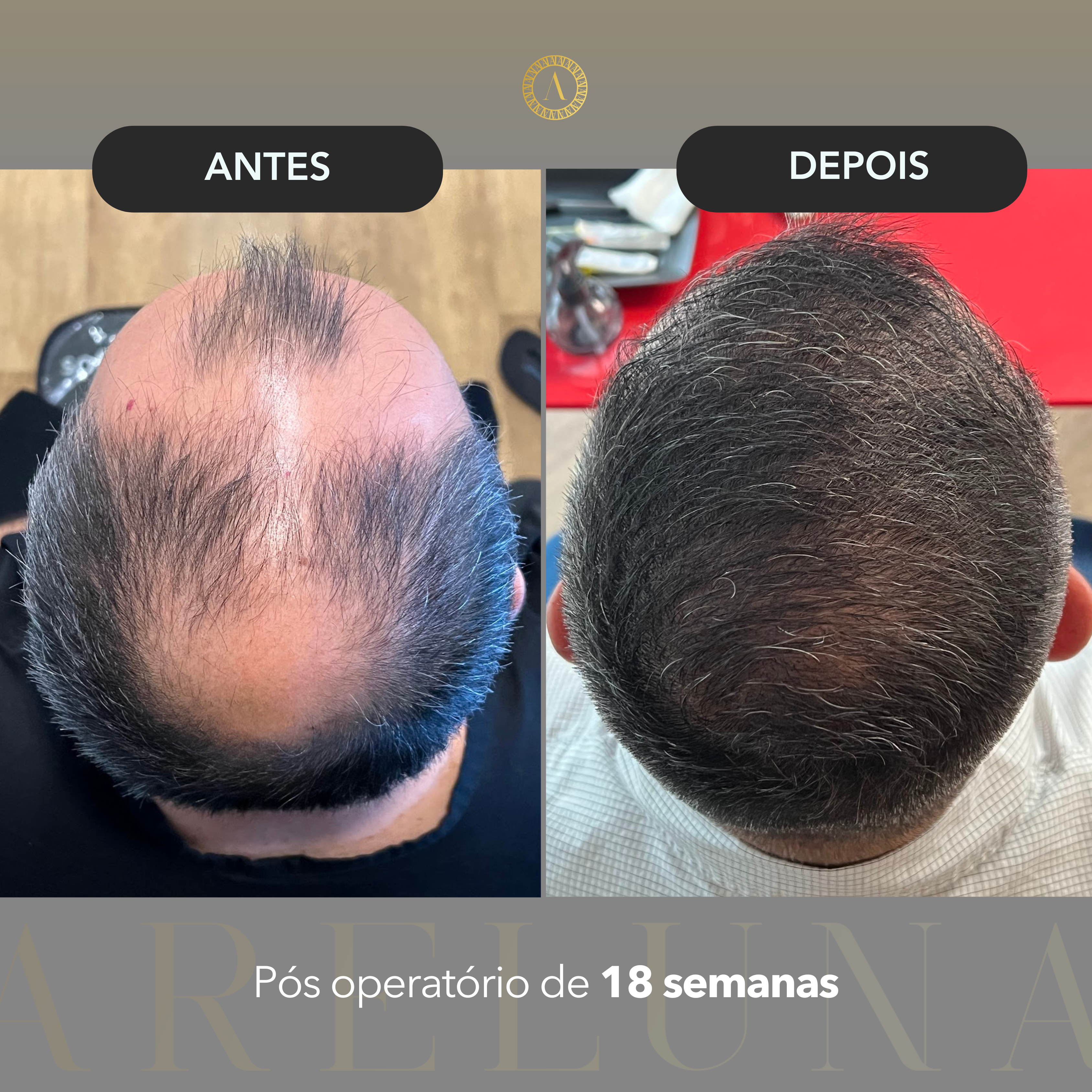 Caso 2 - Transplante Capilar FUE