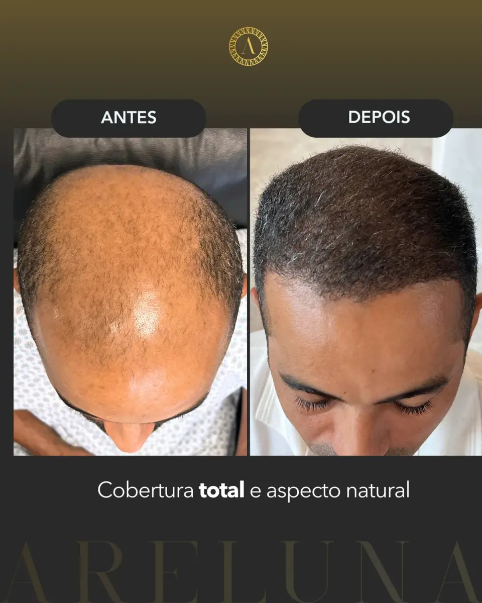 Caso 3 — Reconstrução completa — antes e depois