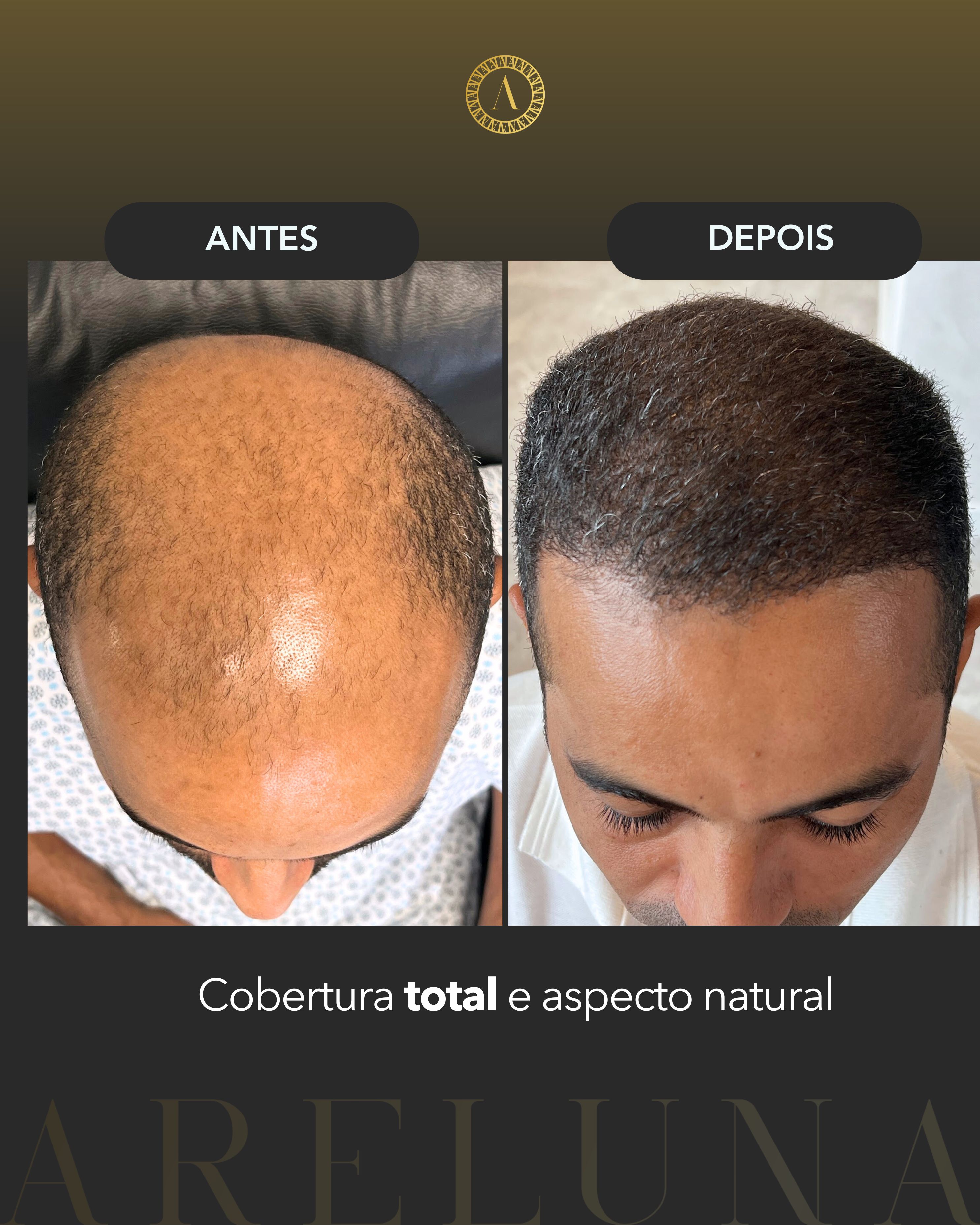 Caso 3 - Transplante Capilar FUE