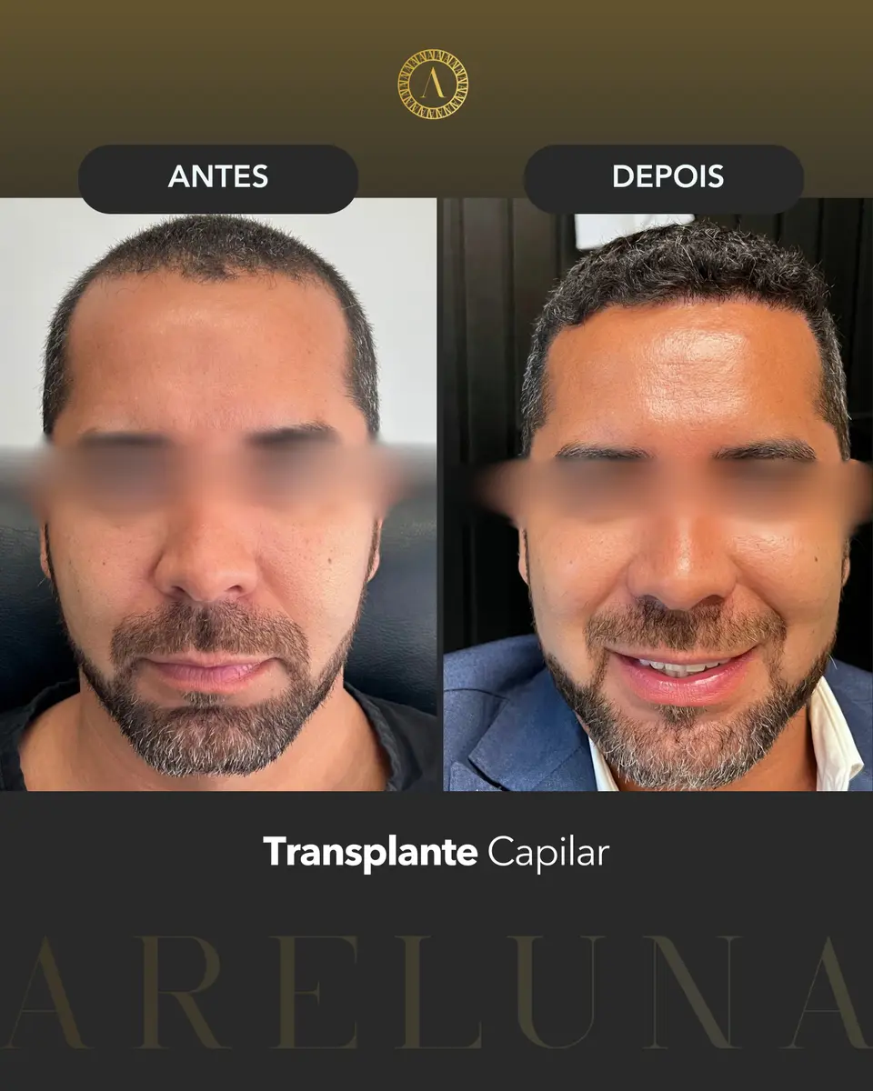 Caso 4 — Linha frontal e região superior (Vista frontal) — antes e depois