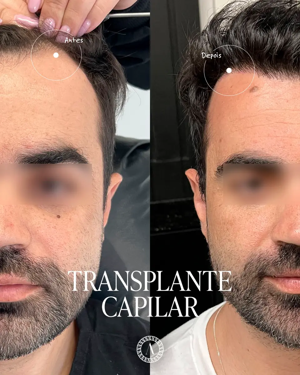 Caso 6 — Entradas e linha frontal (Vista frontal) — antes e depois