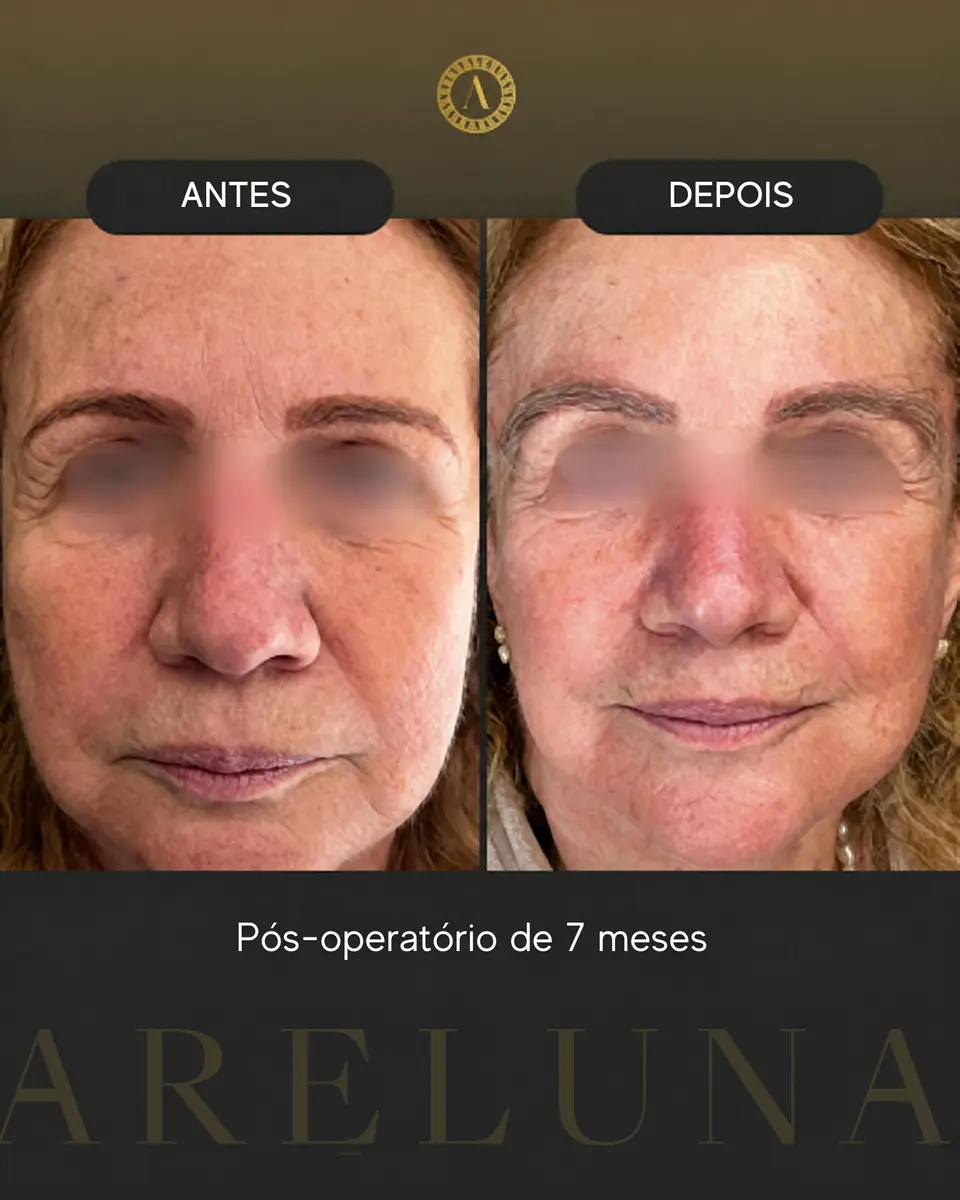 Caso 7 — Transplante de sobrancelhas — antes e depois