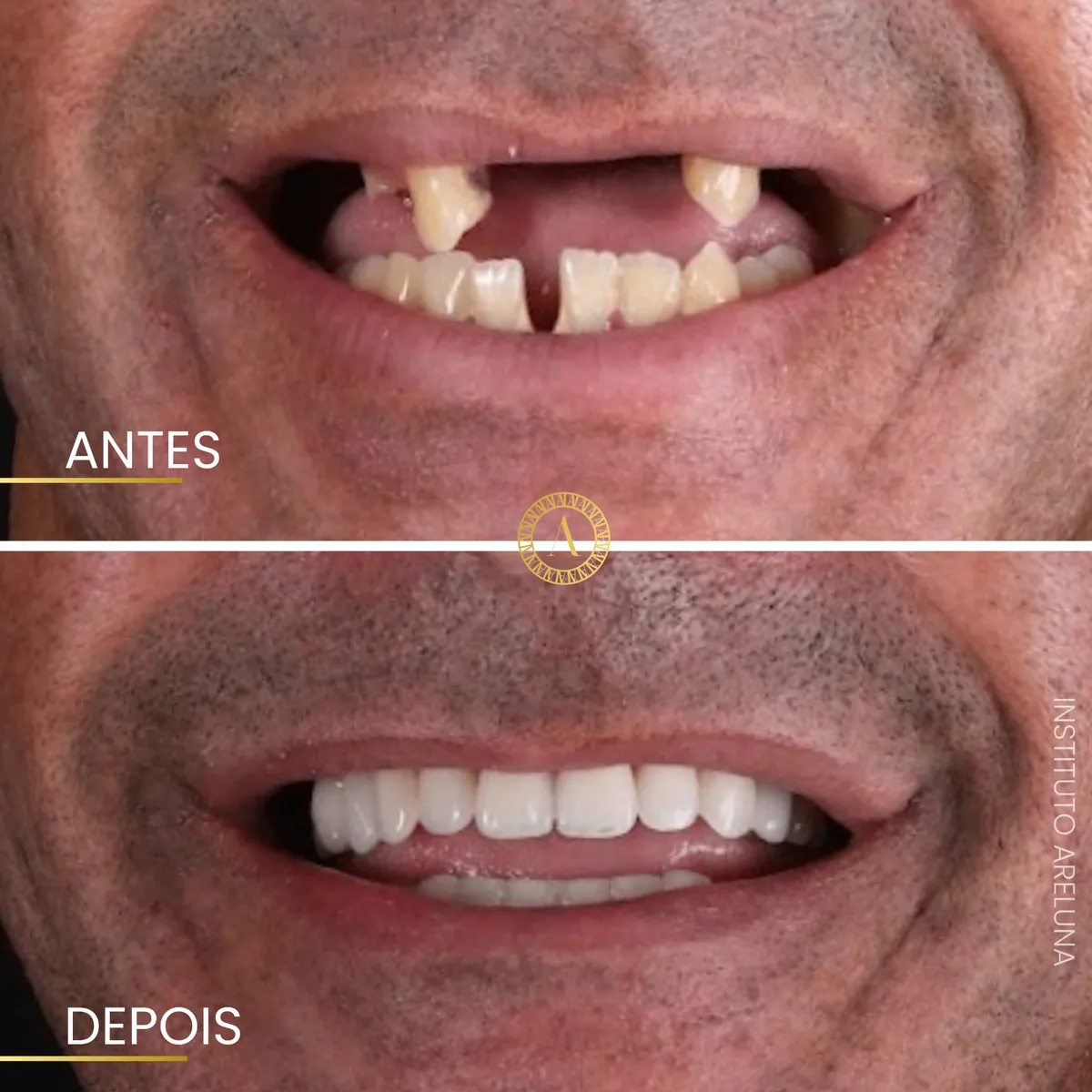 Reabilitação total