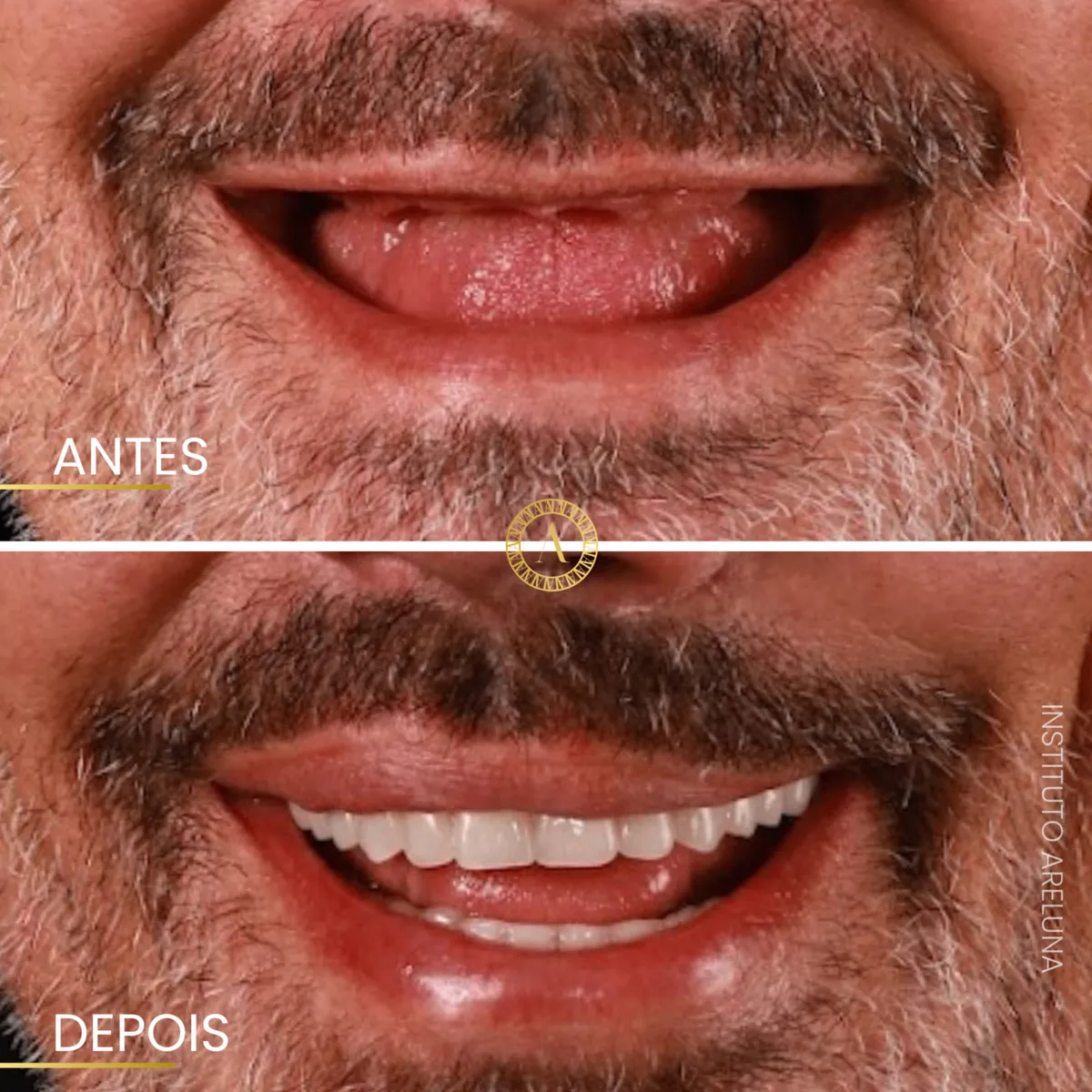 Reabilitação oral com prótese fixa