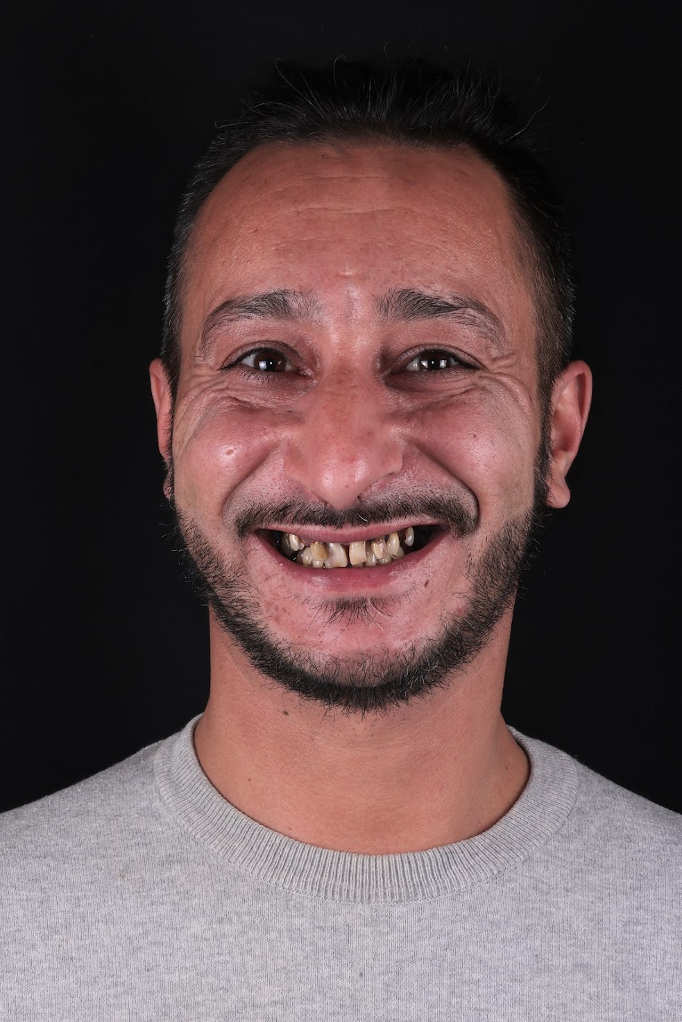Sergio Emanuel antes do tratamento